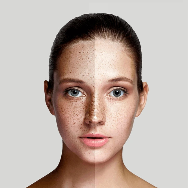 Comparison of Anua vs. Axis-Y products for pigmentation treatment, showing half of a woman's face with pigmentation issues and the other half without.