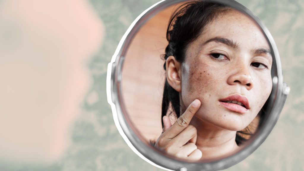 women with dark spots
